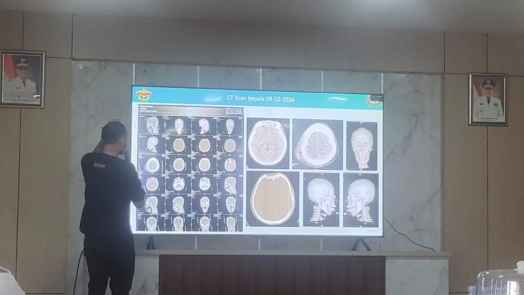 RS dr. Hasri Ainun Habibie Sukses Gelar Operasi Bedah Otak Perdana di Parepare